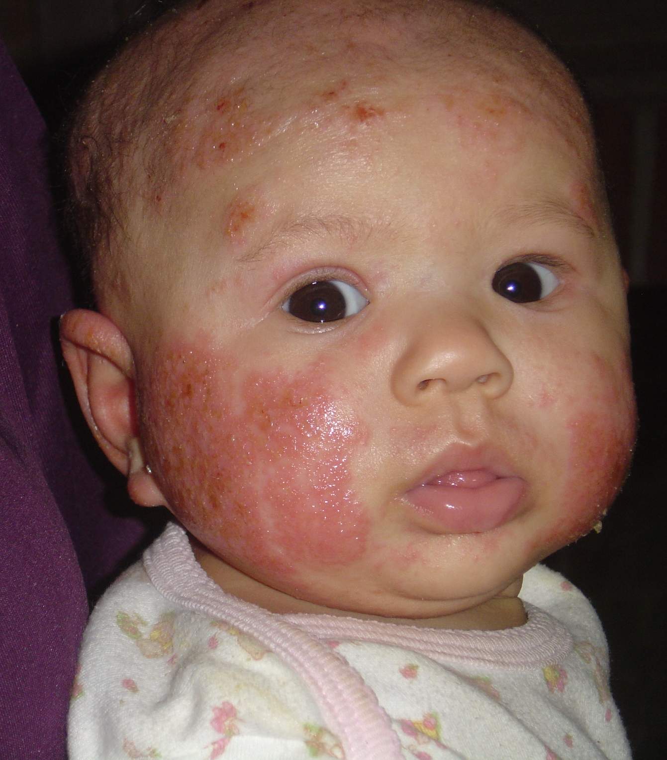 Allergies and neonatal acne baby